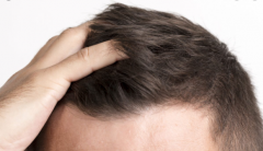 Everything you Need to Know About Hair Transplant